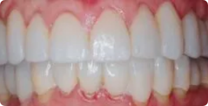 Full-Mouth-Restoration-After-1