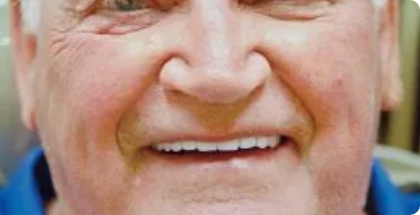 Robert-face-after-1
